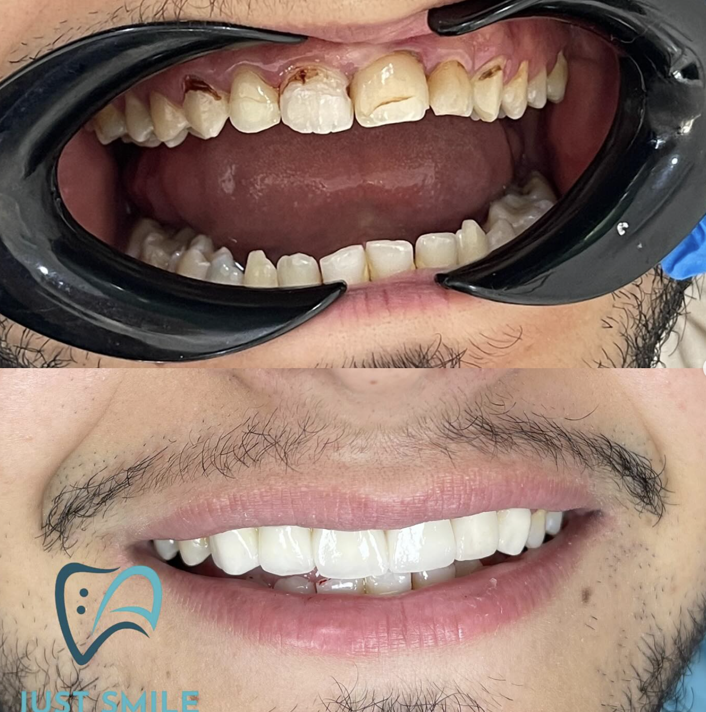 نتيجة قبل وبعد لتجميل الأسنان